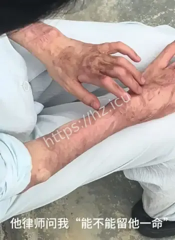 追求遭拒泼硫酸捅刺女子